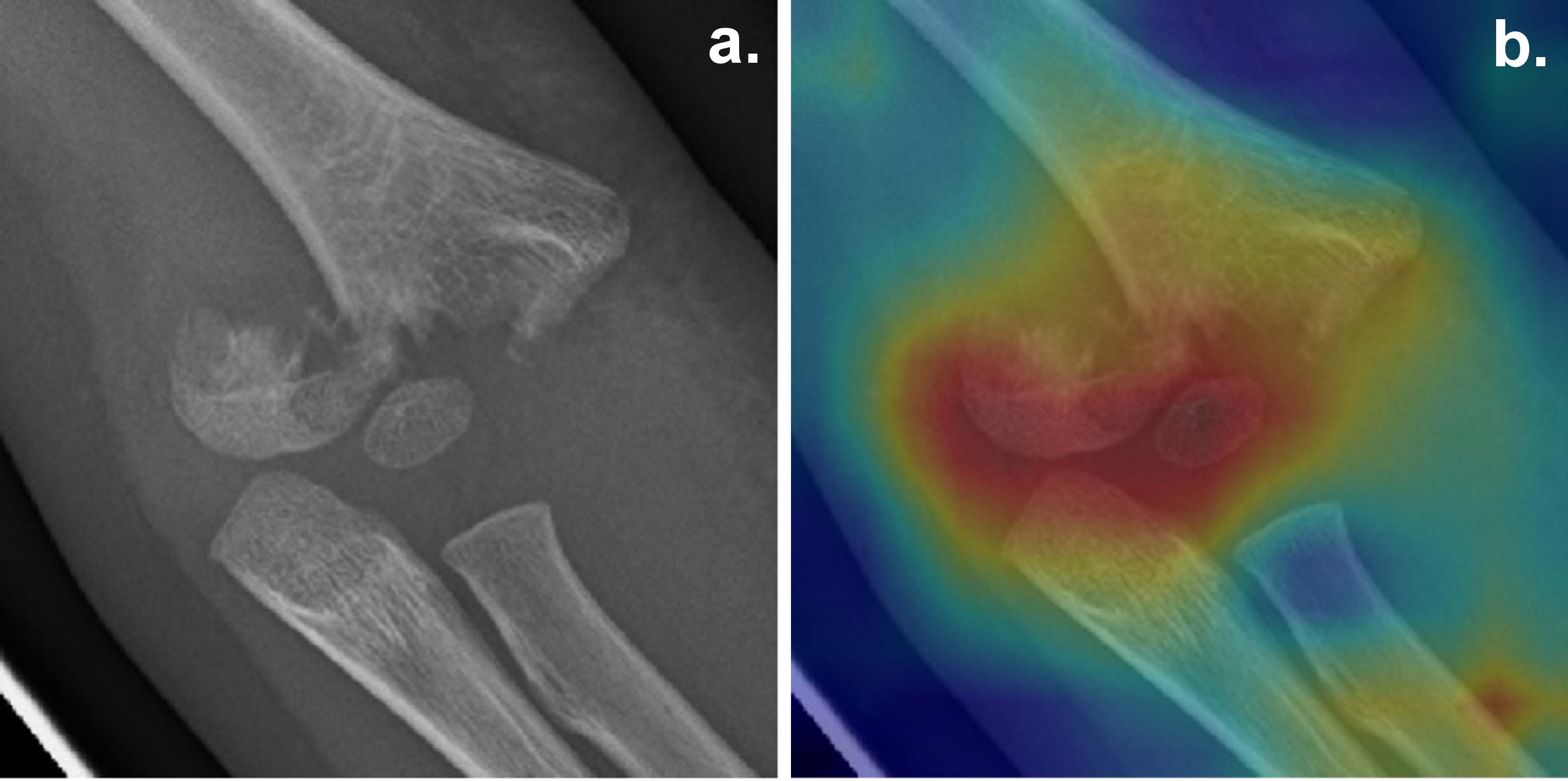 L intelligence artificielle en radiologie quels b n fices Inria